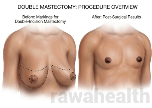 Double Mastectomy in India