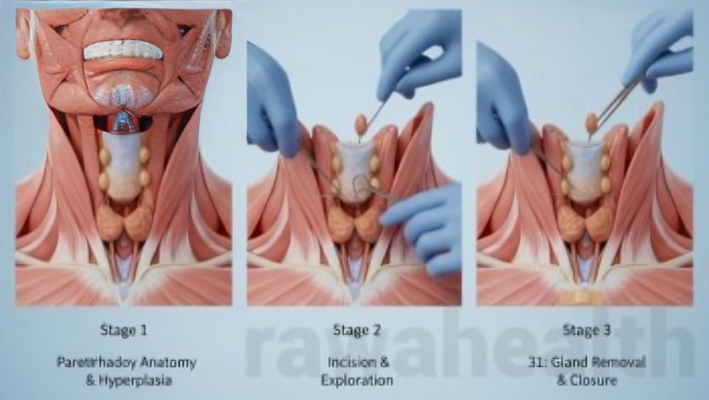 Parathyroid Surgery in India
